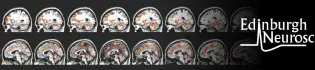 MRI scan 